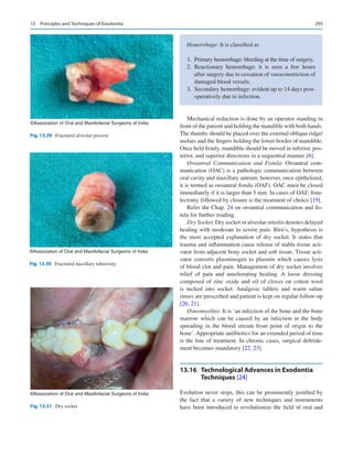 293
Mechanical reduction is done by an operator standing in
front of the patient and holding the mandible with both hands.
The thumbs should be placed over the external oblique ridge/
molars and the fingers holding the lower border of mandible.
Once held firmly, mandible should be moved in inferior, pos-
terior, and superior directions in a sequential manner [6].
Oroantral Communication and Fistula: Oroantral com-
munication (OAC) is a pathologic communication between
oral cavity and maxillary antrum; however, once epithelized,
it is termed as oroantral fistula (OAF). OAC must be closed
immediately if it is larger than 5 mm. In cases of OAF, fistu-
lectomy followed by closure is the treatment of choice [19].
Refer the Chap. 24 on oroantral communication and fis-
tula for further reading.
Dry Socket: Dry socket or alveolar osteitis denotes delayed
healing with moderate to severe pain. Birn’s, hypothesis is
the most accepted explanation of dry socket. It states that
trauma and inflammation cause release of stable tissue acti-
vator from adjacent bony socket and soft tissue. Tissue acti-
vator converts plasminogen to plasmin which causes lysis
of blood clot and pain. Management of dry socket involves
relief of pain and ameliorating healing. A loose dressing
composed of zinc oxide and oil of cloves on cotton wool
is tucked into socket. Analgesic tablets and warm saline
rinses are prescribed and patient is kept on regular follow-up
[20, 21].
Osteomyelitis: It is ‘an infection of the bone and the bone
marrow which can be caused by an infection in the body
spreading in the blood stream from point of origin to the
bone’. Appropriate antibiotics for an extended period of time
is the line of treatment. In chronic cases, surgical debride-
ment becomes mandatory [22, 23].
13.16	 
Technological Advances in Exodontia
Techniques [24]
Evolution never stops, this can be prominently justified by
the fact that a variety of new techniques and instruments
have been introduced to revolutionize the field of oral and
©Association of Oral and Maxillofacial Surgeons of India
Fig. 13.29  Fractured alveolar process
©Association of Oral and Maxillofacial Surgeons of India
Fig. 13.30  Fractured maxillary tuberosity
©Association of Oral and Maxillofacial Surgeons of India
Fig. 13.31  Dry socket
Hemorrhage: It is classified as
	1.	 Primary hemorrhage: bleeding at the time of surgery.
	
2.	Reactionary hemorrhage: it is seen a few hours
after surgery due to cessation of vasoconstriction of
damaged blood vessels.
	3.	 Secondary hemorrhage: evident up to 14 days post-
operatively due to infection.
13  Principles and Techniques of Exodontia
 