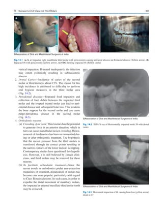 301
vertical impaction. If treated inadequately, the infection
may extent posteriorly resulting in submasseteric
abscess.
	2.	Dental Caries—Incidence of caries of the second
molar or third molar is about 15%. The reason for this
high incidence is attributed to difficulty to perform
oral hygiene measures in the third molar area
(Fig. 14.2).
	3.	Periodontal diseases—Repeated food impaction and
collection of food debris between the impacted third
molar and the erupted second molar can lead to peri-
odontal disease and subsequent bone loss. This weakens
the bone support for the second molar and can cause
pulpo-­
periodontal disease in the second molar
(Fig. 14.3).
	4.	Orthodontic reasons
	(a)	
Crowding of incisors: Third molars has the potential
to generate force in an anterior direction, which in
turn can cause mandibular incisor crowding. Hence,
removal of third molars has been recommended dur-
ing or after orthodontic treatment. The hypothesis
that the mesial pressure from the third molars is
transferred through the contact points resulting in
the narrow contacts of the lower incisors is slipping.
Contemporary studies have questioned this hypoth-
esis. However, it is still believed by certain clini-
cians, and third molars may be removed for these
reasons.
	(b)	
To facilitate orthodontic treatment—Since the
recent trends in orthodontics prefer non-extraction
modalities of treatment, distalization of molars has
become ever more popular, particularly with regard
to Class II malocclusions. In such cases, in order to
expedite the distal movement of maxillary molars,
the impacted or erupted maxillary third molar tooth
may be extracted.
a b c
©Association of Oral and Maxillofacial Surgeons of India
Fig. 14.1 (a, b, c) Impacted right mandibular third molar with pericoronitis causing extraoral abscess (a) Extraoral abscess (Yellow arrow), (b)
Impacted 48 with pericoronitis (yellow arrow), (c) OPG showing impacted 48 (Yellow circle)
©Association of Oral and Maxillofacial Surgeons of India
Fig. 14.2  IOPA X-ray of Horizontally impacted tooth 38 with dental
caries
©Association of Oral and Maxillofacial Surgeons of India
Fig. 14.3  Horizontal impaction of 48 causing bone loss (yellow arrow)
distal to 47
14  Management of Impacted Third Molars
 