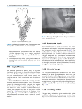 303
functional position. The third molar may also serve as
a bridge abutment. Such cases require multidisci-
plinary evaluation with the prosthodontist and
endodontist.
	5.	 Deeply impacted third molars which do not appear to be
associated with local or systemic pathology must not be
removed.
14.5	 Surgical Anatomy
The mandible comprises of a body which is horseshoe
shaped and has the ramus on either side, which are flat and
broad rami. Each ramus has two processes at the superior
end—the coronoid process, which is more anterior, and
condylar process, which is continuous with the posterior
border.
The mandibular third molar tooth is usually present at
the distal end of the mandibular body, which adjoins a thin
ramus. The body-ramus junction is a weak area that can
fracture if excessive force is employed during the eleva-
tion of the third molar. The tooth lies between the buccal
cortical plate, which is thick, and the thin lingual cortical
plate (Fig. 14.6). In most instances, the thickness of the
lingual plate may be less than 1 mm, and the tooth may
get displaced into the lingual pouch if untoward force is
applied.
14.5.1	 Neurovascular Bundle
The mandibular canal lies beside or below the third molar
roots. Usually, the canal lies slightly buccal and apical to the
third molar roots, but this varies frequently (Fig. 14.7). The
canal contains the inferior alveolar neurovascular bundle
including the artery, vein, and nerve within a sheath of fascia.
The third molar roots may sometimes be indented by the
canal, but actual penetration is rare. In these cases, attempt-
ing to elevate fractured root tips may result in the displace-
ment of the tips into the mandibular canal. If the canal vessels
get injured by instruments or forceful intrusion of the tooth
roots, profuse hemorrhage may result.
14.5.2	 Retromolar Triangle
This is a depressed roughened area behind the third molar
bounded by the buccal and lingual alveolar ridge crests. The
retromolar fossa is a shallow depression that occurs just lat-
eral to the retromolar triangle. Mandibular vessel branches
may emerge at the fossa or triangle and can be injured during
surgical exposure of the third molar region if the incision is
not taken laterally. This can result in brisk hemorrhage
(Fig. 14.8).
14.5.3	 
Facial Artery and Vein
The facial artery and anterior facial vein are related to the
mandibular body, anterior to the masseter muscle, where
they cross the inferior border of the mandible. They lie below
©Association of Oral and Maxillofacial Surgeons of India
Fig. 14.6  Coronal section of mandible in the region of the third molar
showing a thick buccal alveolar bone and a thin lingual plate
©Association of Oral and Maxillofacial Surgeons of India
Fig. 14.7  Radiograph showing the proximity of impacted third molar
roots to the mandibular canal
14  Management of Impacted Third Molars
 