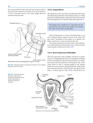 304
the second and third molar teeth and may be injured when a
buccal incision is placed at an inferior level. To avoid this, it
is best to start the incision at the sulcus depth and move
upward toward the tooth.
14.5.4	 Lingual Nerve
The lingual nerve often runs below and behind the third molar,
and contacts the periosteum over the lingual cortex at a sublin-
gual level. Cardinal anatomic studies have shown the close rela-
tion of the lingual nerve to the lower third molar region [8, 9].
Since the lingual nerve is close to the third molar, it is at
risk of damage during surgical removal of the tooth. This
may lead to anesthesia of the tongue in its anterior two-­
thirds, and also loss of taste sensation in this area.
The surgeon should also be aware of the course and direc-
tion of the mylohyoid and long buccal nerve to prevent inad-
vertent injuries to these nerves (Fig. 14.9).
14.5.5	 Bone Trajectories of Mandible
The bone trajectories of the mandible, referred to as grains,
course in a longitudinal direction. Even though the technique
of chisel and mallet has almost become obsolete, it is impor-
tant to know the bone trajectories. On the buccal side, a hori-
zontal chisel cut that is oriented parallel to the superior
border may cause extensive splitting till the first molar region
due to the grain direction. To prevent this, the operator must
make a “vertical stop cut” (Fig. 14.10), with the bevel ori-
The lingual nerve usually lies 2.3 mm below the lin-
gual alveolar crest, and 0.6 mm medial to the mandi-
ble, when viewed from a frontal plane.
©Association of Oral and Maxillofacial Surgeons of India
Fig. 14.8  Schematic diagram showing the retromolar vessel emerging
through retromolar foramen
©Association of Oral and Maxillofacial Surgeons of India
Impacted third molar
Fig. 14.9  Schematic diagram
showing coronal section
through the third molar region
and the relationship of
important anatomical
structures
G. Varghese
 