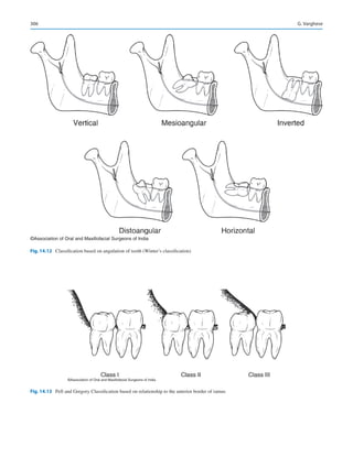 306
©Association of Oral and Maxillofacial Surgeons of India
Fig. 14.12  Classification based on angulation of tooth (Winter’s classification)
©Association of Oral and Maxillofacial Surgeons of India
Fig. 14.13  Pell and Gregory Classification based on relationship to the anterior border of ramus
G. Varghese
 