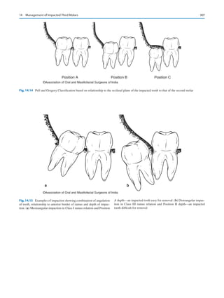 307
©Association of Oral and Maxillofacial Surgeons of India
Fig. 14.14  Pell and Gregory Classification based on relationship to the occlusal plane of the impacted tooth to that of the second molar
a b
©Association of Oral and Maxillofacial Surgeons of India
Fig. 14.15  Examples of impaction showing combination of angulation
of tooth, relationship to anterior border of ramus and depth of impac-
tion. (a) Mesioangular impaction in Class I ramus relation and Position
A depth—an impacted tooth easy for removal. (b) Distoangular impac-
tion in Class III ramus relation and Position B depth—an impacted
tooth difficult for removal
14  Management of Impacted Third Molars
 