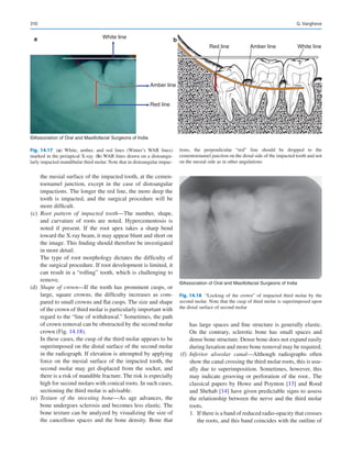 310
the mesial surface of the impacted tooth, at the cemen-
toenamel junction, except in the case of distoangular
impactions. The longer the red line, the more deep the
tooth is impacted, and the surgical procedure will be
more difficult.
	(c)	 Root pattern of impacted tooth—The number, shape,
and curvature of roots are noted. Hypercementosis is
noted if present. If the root apex takes a sharp bend
toward the X-ray beam, it may appear blunt and short on
the image. This finding should therefore be investigated
in more detail.
The type of root morphology dictates the difficulty of
the surgical procedure. If root development is limited, it
can result in a “rolling” tooth, which is challenging to
remove.
	(d)	 Shape of crown—If the tooth has prominent cusps, or
large, square crowns, the difficulty increases as com-
pared to small crowns and flat cusps. The size and shape
of the crown of third molar is particularly important with
regard to the “line of withdrawal.” Sometimes, the path
of crown removal can be obstructed by the second molar
crown (Fig. 14.18).
In these cases, the cusp of the third molar appears to be
superimposed on the distal surface of the second molar
in the radiograph. If elevation is attempted by applying
force on the mesial surface of the impacted tooth, the
second molar may get displaced from the socket, and
there is a risk of mandible fracture. The risk is especially
high for second molars with conical roots. In such cases,
sectioning the third molar is advisable.
	(e)	 Texture of the investing bone—As age advances, the
bone undergoes sclerosis and becomes less elastic. The
bone texture can be analyzed by visualizing the size of
the cancellous spaces and the bone density. Bone that
has large spaces and fine structure is generally elastic.
On the contrary, sclerotic bone has small spaces and
dense bone structure. Dense bone does not expand easily
during luxation and more bone removal may be required.
	(f)	 Inferior alveolar canal—Although radiographs often
show the canal crossing the third molar roots, this is usu-
ally due to superimposition. Sometimes, however, this
may indicate grooving or perforation of the root.. The
classical papers by Howe and Poynton [13] and Rood
and Shehab [14] have given predictable signs to assess
the relationship between the nerve and the third molar
roots.
	 1.	 If there is a band of reduced radio-opacity that crosses
the roots, and this band coincides with the outline of
White line
Amber line
Red line
White line
Amber line
Red line
a b
©Association of Oral and Maxillofacial Surgeons of India
Fig. 14.17 (a) White, amber, and red lines (Winter’s WAR lines)
marked in the periapical X-ray. (b) WAR lines drawn on a distoangu-
larly impacted mandibular third molar. Note that in distoangular impac-
tions, the perpendicular “red” line should be dropped to the
cementoenamel junction on the distal side of the impacted tooth and not
on the mesial side as in other angulations
©Association of Oral and Maxillofacial Surgeons of India
Fig. 14.18  “Locking of the crown” of impacted third molar by the
second molar. Note that the cusp of third molar is superimposed upon
the distal surface of second molar
G. Varghese
 
