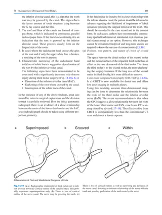 311
the inferior alveolar canal, this is a sign that the tooth
root may be grooved by the canal. This sign reflects
the lesser amount of tooth structure lying between
the X-ray source and the film.
	 2.	 The roof and floor of the canals are formed of com-
pact bone, which is indicated by continuous, parallel
radio-opaque lines. If the lines lose continuity, it is an
indication that the root is grooved by the inferior
alveolar canal. These grooves usually form on the
lingual side of the roots.
	 3.	 In cases where the radiolucent band crosses the apex
of the root and if only the upper white line is broken,
a notching of the root is present.
	 4.	Characteristic narrowing of the radiolucent band
with loss of white lines is suggestive of perforation of
the root by the inferior alveolar canal.
The following signs have been demonstrated to be
associated with a significantly increased risk of nerve
injury during third molar surgery: (Fig. 14.19a, b, c)
•	 Diversion of the inferior alveolar canal (IAC).
•	 Darkening of the root where crossed by the canal.
•	 Interruption of the white lines of the canal.
In the presence of any of the above findings, great care
should be taken in surgical exploration and the decision
to treat is carefully reviewed. If on the initial panoramic
radiograph there is an evidence of a close relationship
between the roots of the lower third molar and the IAC,
a second radiograph should be taken using different pro-
jection geometry.
If the third molar is found to be in close relationship with
the inferior alveolar canal, the patient should be informed in
advance regarding the likelihood of impairment of labial
sensation following the surgical removal of the tooth. This
should be recorded in the case record and in the consent
form. In such cases, authors have recommended coronec-
tomy (partial tooth removal, intentional root retention, par-
tial odontectomy) as an option. However, this technique
cannot be considered foolproof and long-term studies are
required to know the success of coronectomies [15, 16]
	(g)	 Position, root pattern, and nature of crown of second
molar.
The space between the distal surface of the second molar
and the mesial surface of the impacted third molar has an
effect on the ease of removal of the third molar. The closer
the third molar is to the second molar, the more challeng-
ing the surgery becomes. If the long axis of the second
molar is tilted distally, it is more difficult to remove.
Cone beam computed tomography (CBCT) (Fig. 14.20a,
b, c) CBCT is now available for dental use and offers
low dose imaging in multiple planes.
Using this modality, accurate three-dimensional imag-
ing can be done to determine the relationship between
the roots of the third molar and the inferior alveolar
nerve (IAN). The recent recommendation is that when
the OPG suggests a close relationship between the roots
of the lower third molar and IAN, cone beam CT scan-
ning should be advised [17–19]. The effective dose from
CBCT is comparatively less than the conventional CT
scan and also at a lower expense.
a b c
©Association of Oral and Maxillofacial Surgeons of India
Fig. 14.19 (a–c) Radiographic relationship of third molar root to infe-
rior alveolar nerve (a) Cortical outline of the canal is intact. This prob-
ably represents superimposition only. (b) There is loss of cortical
outline of the nerve canal. The nerve may be grooving the tooth. (c)
There is loss of cortical outline as well as narrowing and deviation of
the nerve canal, denoting an intimate relationship of the nerve with the
tooth and possibly perforation of the tooth roots by the nerve
14  Management of Impacted Third Molars
 