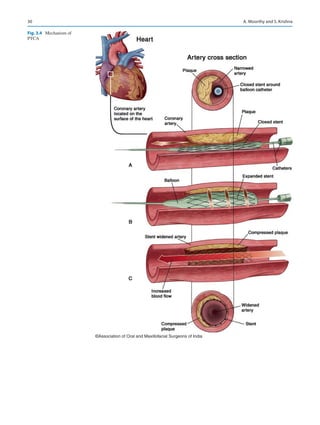 30
©Association of Oral and Maxillofacial Surgeons of India
Fig. 3.4  Mechanism of
PTCA
A. Moorthy and S. Krishna
 
