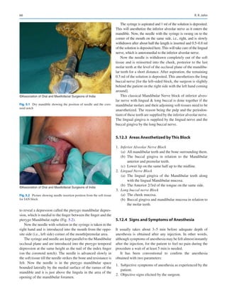 66
to reveal a depression called the pterygo mandibular depres-
sion, which is medial to the finger between the finger and the
pterygo Mandibular raphe (Fig. 5.2).
Now the needle with solution in the syringe is taken in the
right hand and is introduced into the mouth from the oppo-
site side (i.e., left side) corner of the mouth/premolar area.
The syringe and needle are kept parallel to the Mandibular
occlusal plane and are introduced into the pterygo temporal
depression at the same height as the nail of the index finger
(on the coronoid notch). The needle is advanced slowly in
the soft tissue till the needle strikes the bone and resistance is
felt. Now the needle is in the pterygo mandibular space
bounded laterally by the medial surface of the ramus of the
mandible and it is just above the lingula in the area of the
opening of the mandibular foramen.
The syringe is aspirated and 1 ml of the solution is deposited.
This will anesthetize the inferior alveolar nerve as it enters the
mandible. Now, the needle with the syringe is swung on to the
corner of the mouth on the same side, i.e., right, and is slowly
withdrawn after about half the length is inserted and 0.5–0.8 ml
of the solution is deposited here.This will take care of the lingual
nerve, which is anteromedial to the inferior alveolar nerve.
Now the needle is withdrawn completely out of the soft
tissue and is reinserted into the cheek, posterior to the last
molar teeth at the level of the occlusal plane of the mandibu-
lar teeth for a short distance. After aspiration, the remaining
0.5 ml of the solution is deposited. This anesthetizes the long
buccal nerve [for the left-sided block, the surgeon is slightly
behind the patient on the right side with the left hand coming
around].
This classical Mandibular Nerve block of inferior alveo-
lar nerve with lingual  long buccal is done together if the
mandibular molars and their adjoining soft tissues need to be
anaesthetized. The reason being the pulp and the periodon-
tium of these teeth are supplied by the inferior alveolar nerve.
The lingual gingiva is supplied by the lingual nerve and the
buccal gingiva by the long buccal nerve.
5.12.3	 
Areas Anesthetized by This Block
	1.	 Inferior Alveolar Nerve Block
	 (a)	 All mandibular teeth and the bone surrounding them.
	 (b)	The buccal gingiva in relation to the Mandibular
anterior and premolar teeth.
	 (c)	 Lower lip on the same half up to the midline.
	2.	 Lingual Nerve Block
	 (a)	The lingual gingiva of the Mandibular teeth along
with the lingual Mandibular mucosa.
	 (b)	 The Anterior 2/3rd of the tongue on the same side.
	3.	 Long buccal nerve Block
	 (a)	 The cheek mucosa.
	 (b)	 Buccal gingiva and mandibular mucosa in relation to
the molar teeth.
5.12.4	 
Signs and Symptoms of Anesthesia
It usually takes about 3–5  min before adequate depth of
anesthesia is obtained after any injection. In other words,
although symptoms of anesthesia may be felt almost instantly
after the injection, for the patient to feel no pain during the
procedure a wait of at least 5 min is needed.
It has been conventional to confirm the anesthesia
obtained with two parameters:
	1.	 Subjective symptoms of anesthesia as experienced by the
patient.
	
2.	 Objective signs elicited by the surgeon.
©Association of Oral and Maxillofacial Surgeons of India
Fig. 5.1  Dry mandible showing the position of needle and the coro-
noid notch
©Association of Oral and Maxillofacial Surgeons of India
Fig. 5.2  Picture showing needle insertion position from the soft tissue
for IAN block
R. R. John
 