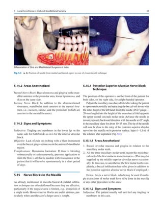 69
5.14.2	 Areas Anesthetized
Mental Nerve Block: Buccal mucosa and gingiva in the man-
dible anterior to the premolar area, lower lip mucosa, and
skin on the same side.
Incisive Nerve Block: In addition to the aforementioned
structures, mandibular teeth anterior to the mental fora-
men, i.e., incisors, canine, and the premolars (which are
anterior to the mental foramen).
5.14.3	 Signs and Symptoms
Subjective: Tingling and numbness in the lower lip on the
same side for both blocks as it is for the inferior alveolar
block.
Objective: Lack of pain on probing with a blunt instrument
overthebuccalgingival/mucosaintheanteriorMandibular
region.
Complications: Hematoma formation: If there is bleeding
submucosally or subcutaneously, pressure application to
stem the flow is all that is needed, with reassurance to the
patient that it will resolve spontaneously in a short period
of days.
5.15	 
Nerve Blocks in the Maxilla
As already mentioned, in maxilla buccal  palatal infiltra-
tion techniques are often followed because they are effective,
particularly if the surgical area is limited, e.g., extraction of
a single tooth. However nerve blocks are useful at times, par-
ticularly when anesthesia of a larger area is sought.
5.15.1	 
Posterior Superior Alveolar Nerve Block
Technique
The position of the operator is on the front of the patient for
both sides, on the right side, for a right-handed operator.
Palpate the maxillary mucobuccal fold after asking the patient
to open mouth partially and retracting the buccal soft tissue with
the index finger of the left hand. Insert the needle (25/27 gauge—
20-mm length) into the height of the mucobuccal fold opposite
the upper second (second) molar tooth. Advance the needle in
inward, upward, backward direction with the needle at 45° angle
to the maxillary plane for about 10–15 mm. The tip of the needle
will now be close to the entry of the posterior superior alveolar
nerve into the maxilla on its posterior surface. Inject 1–1.5 ml of
the solution after aspiration (Fig. 5.4).
5.15.1.1  Areas Anesthetized
	
1.	Buccal alveolar mucosa and gingiva in relation to the
maxillary molar teeth.
	
2.	 All the three maxillary molar teeth except the mesiobuc-
cal root of the first molar in some instances. (This may be
supplied by the middle superior alveolar nerve occasion-
ally. In this case, to anesthetize the first molar tooth com-
pletely, a buccal infiltration has to be given in addition to
the posterior superior alveolar nerve block if employed.)
Hence, this is a nerve block, which may be used if multi-
ple extractions of molar teeth have to be done in the maxilla
or any other procedure in this area.
5.15.1.2  Signs and Symptoms
Subjective: The patient usually will not feel any tingling or
numbness in this case.
a b
©Association of Oral and Maxillofacial Surgeons of India
Fig. 5.3 (a, b) Position of needle from medial and lateral aspect in case of closed-mouth technique
5  Local Anesthesia in Oral and Maxillofacial Surgery
 