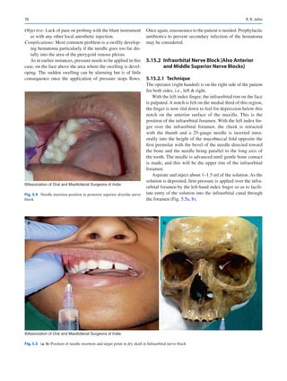 70
Objective: Lack of pain on probing with the blunt instrument
as with any other local anesthetic injection.
Complications: Most common problem is a swiftly develop-
ing hematoma particularly if the needle goes too far dis-
tally into the area of the pterygoid venous plexus.
As in earlier instances, pressure needs to be applied in this
case, on the face above the area where the swelling is devel-
oping. The sudden swelling can be alarming but is of little
consequence once the application of pressure stops flows.
Once again, reassurance to the patient is needed. Prophylactic
antibiotics to prevent secondary infection of the hematoma
may be considered.
5.15.2	 
Infraorbital Nerve Block [Also Anterior
and Middle Superior Nerve Blocks]
5.15.2.1  Technique
The operator (right handed) is on the right side of the patient
for both sides, i.e., left  right.
With the left index finger, the infraorbital rim on the face
is palpated. A notch is felt on the medial third of this region,
the finger is now slid down to feel for depression below this
notch on the anterior surface of the maxilla. This is the
position of the infraorbital foramen. With the left index fin-
ger over the infraorbital foramen, the cheek is retracted
with the thumb and a 25-gauge needle is inserted intra-
orally into the height of the mucobuccal fold opposite the
first premolar with the bevel of the needle directed toward
the bone and the needle being parallel to the long axis of
the tooth. The needle is advanced until gentle bone contact
is made, and this will be the upper rim of the infraorbital
foramen.
Aspirate and inject about 1–1.5 ml of the solution. As the
solution is deposited, firm pressure is applied over the infra-
orbital foramen by the left-hand index finger so as to facili-
tate entry of the solution into the infraorbital canal through
the foramen (Fig. 5.5a, b).
a b
©Association of Oral and Maxillofacial Surgeons of India
Fig. 5.5 (a, b) Position of needle insertion and target point in dry skull in Infraorbital nerve block
©Association of Oral and Maxillofacial Surgeons of India
Fig. 5.4  Needle insertion position in posterior superior alveolar nerve
block
R. R. John
 