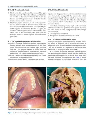 71
5.15.2.2  Areas Anesthetized
	
1.	 The lower eyelid, lateral side of the nose, and the upper
lip on the same side (This is due to blockade of the termi-
nal branches of the infraorbital nerve after it exits the
foramen and will happen irrespective of whether the solu-
tion has entered into the foramen)
	
2.	 The buccal gingiva  mucosa, as well as the upper ante-
rior and premolar teeth on the same side as well as the
mesiobuccal root of the first molar if it is supplied by the
middle superior alveolar nerve. (For this to happen, the
anesthetic solution injected should diffuse into the infra-
orbital canal in the floor of the orbit from where the
branches, anterior,  middle superior alveolar nerve are
given off.)
5.15.2.3  
Signs and Symptoms of Anesthesia
Subjective: Tingling  numbness in the areas supplied by the
terminal branches of the infraorbital nerve, i.e., the lower
eyelid, lateral side of the nose, and the upper lip on the
same side. (This symptom does not necessarily mean that
the anterior  middle superior alveolar nerves have been
anesthetized. This can be confirmed only objectively.)
Objective: Like always, lack of pain on probing with a blunt
instrument in the area anesthetized.
Complication: Are few. Rarely a hematoma may develop.
5.15.3	 Palatal Anesthesia
Injection into the palatal tissues, whether an infiltration or a
nerve block, is the most painful. The reason is the palatal
mucoperiostem is tightly adherent to the bone and there is no
easy space for the solution to flow. This also makes the pro-
cess of injection difficult as often there is backflow due to the
resistance offered.
Most often, particularly when a single tooth is involved,
infiltration anesthesia is preferred in the palate. However,
two nerve blocks are often used particularly when a larger
area is involved
	
1.	 Greater palatine nerve block
	
2.	 Nasopalatine or Anterior Palatine Nerve block.
5.15.3.1  
Greater Palatine Nerve Block
Technique: The greater palatine foramen in the adult is usu-
ally present on the palatal side of the second molar tooth at
the junction of the alveolus and the horizontal palatine bone.
(This may be palpated as a depression in this area but need
not be done for the purpose of the nerve block.)
A 25/27-gauge short needle is inserted from the opposite
side with the operator standing in front (for both sides of the
patient) into the area palatal to the second molar at the junc-
tion of the alveolus  the palatine bone (Fig. 5.6a, b). A little
solution is deposited (0.1–0.2 ml) at the point of entry and
a b
©Association of Oral and Maxillofacial Surgeons of India
Fig. 5.6 (a, b) Intraoral and in dry skull showing insertion of needle in greater palatine nerve block
5  Local Anesthesia in Oral and Maxillofacial Surgery
 