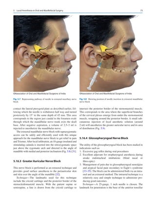 73
contact the lateral pterygoid plate as described earlier, fol-
lowing which the needle is withdrawn half way and turned
posteriorly by 15° to the same depth of 45 mm. This area
corresponds to the region just caudal to the foramen ovale
through which the mandibular nerve trunk exits the skull
base. After negative aspiration, a volume of 2.5–3  ml is
injected to anesthetize the mandibular nerve.
The extraoral mandibular nerve block with suprazygomatic
access can be safely and efficiently used with this unique
approach for the mandibular nerve block to get relief in pain
and Trismus.After local infiltration, an 18-gauge insulated and
stimulating cannula is inserted into the retrozygomatic space
just above the zygomatic arch and directed to the angle of
mandible with medial and posterior inclination (Fig. 5.8) [31].
5.16.3	 
Greater Auricular Nerve Block
This nerve block is performed as an extraoral technique and
provides good surface anesthesia to the periauricular skin
and skin over the angle of the mandible [32].
Technique—The landmarks used for this technique
include the cricoid cartilage and the posterior border of the
sternocleidomastoid muscle. With the patient supine or
semisupine, a line is drawn from the cricoid cartilage to
intersect the posterior border of the sternomastoid muscle.
This corresponds to the area where the superficial branches
of the cervical plexus emerge from under the sternomastoid
muscle, wrapping around the posterior border. A small sub-
cutaneous injection of local anesthetic solution (around
2 ml) will anesthetize the greater auricular nerve and its area
of distribution (Fig. 5.9).
5.16.4	 
Glossopharyngeal Nerve Block
The utility of the glossopharyngeal block has been studied in
indications such as:
	
1.	 Excessive gag reflex during oral procedures
	
2.	Excellent adjuvant for oropharyngeal anesthesia during
awake endotracheal intubations (blind nasal or
fibro-optic)
	
3.	 Management of pain due to glossopharyngeal neuralgias
and atypical facial pain secondary to Eagle’s syndrome
[33–35]. The block can be administered both via an intra-
oral and an extraoral method. The intraoral technique is a
relatively easy and simple technique to administer pro-
ducing good outcomes.
Technique—A 25-gauge, 1 inch needle is chosen. The
landmark for penetration is the base of the anterior tonsillar
©Association of Oral and Maxillofacial Surgeons of India
Fig. 5.7  Representing pathway of needle in extraoral maxillary nerve
block
©Association of Oral and Maxillofacial Surgeons of India
Fig. 5.8  Showing position of needle insertion in extraoral mandibular
nerve block
5  Local Anesthesia in Oral and Maxillofacial Surgery
 