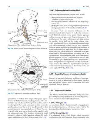 74
pillar lateral to the base of the tongue. The syringe is posi-
tioned with the barrel near the maxillary premolar of the con-
tralateral side with the needle facing the base of the anterior
tonsillar pillar. The tongue is retracted medially to provide
good visualization of the involved site. The needle is then
made to pierce the mucosa and advance by 5 mm. This cor-
responds to the target site for the glossopharyngeal nerve in
the submucosal space. After judicious aspiration, if found
negative, a volume of 3 ml of anesthetic solution (2% ligno-
caine) is administered to block the nerve trunk (Fig. 5.10).
5.16.5	 
Sphenopalatine Ganglion Block
Indications for sphenopalatine ganglion block include:
	
1.	 Management of cluster headaches and migraine
	
2.	 Treatment for atypical facial pain
	
3.	 Palliative pain control for patients with maxillary malig-
nancies and
	4.	 Pre-Emptive nerve blockade for perioperative pain control
in surgical procedures of the maxilla and palate [36, 37]
Technique—There are numerous techniques for the
administration of sphenopalatine block, but the most com-
monly followed methods are the greater palatine approach
and the transmucosal approach in the posterior aspect of the
middle meatus. The greater palatine approach is the same as
the maxillary nerve block via the greater palatine canal,
which simultaneously blocks the sphenopalatine ganglion as
well. The transmucosal method, which is most commonly
followed, maybe done blind or using endoscopic guidance.A
cotton pledget on a long application stick is dipped in anes-
thetic solution or gel and is advanced transnasally to the pos-
terior aspect of the middle turbinate to reach the end of the
middle meatus. This corresponds to the level of the spheno-
palatine ganglion, which is a very superficial structure. The
local anesthetic gel is then deposited, which produces anes-
thesia through transmucosal perfusion. Another recent tech-
nique involves the submucosal injection of the anesthetic
solution into the posterior aspect of the middle meatus for
achieving the block (Fig. 5.11) [37].
5.17	 
Recent Advances in Local Anesthesia
Research is ongoing to find newer modalities of pain man-
agement. In order to administer local anesthesia with less
pain and adverse effects, newer technologies have been
developed. Some of them are:
5.17.1	 Vibrotactile Devices
This device is based on the Gate Control theory, which pro-
poses that pain during injection can be decreased by simulta-
neous stimulation of nerve fibers by vibration.
5.17.1.1  Vibraject [38]
An attachment, which is battery operated, is snapped on to
the barrel to deliver strong vibrations, which is felt by the
patient and therefore reducing the perception of pain.
5.17.1.2  Dental Vibe [39]
It is a handheld device, which delivers pulsed percussive
oscillations to the site of injection, thereby closing the pain
©Association of Oral and Maxillofacial Surgeons of India
Fig. 5.10  Target area for glossopharyngeal nerve block
©Association of Oral and Maxillofacial Surgeons of India
Fig. 5.9  Showing position of needle for greater auricular nerve block
R. R. John
 