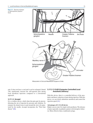 75
gate. It does not have a cord and it can be recharged. Dental
vibe significantly lowered the self-reported pain during
local anesthesia injections compared to a conventional
approach.
5.17.1.3  Accupal
It is a cordless device, which shuts the pain gate by precon-
ditioning the site of injection by pressure and vibration. To
energize the dental tissue in and around the site to be punc-
tured by the needle, Accupal incorporates the “Pain Gate
theory” [40].
5.17.2	 
C-CLAD (Computer-Controlled Local
Anesthetic Delivery)
With this device, there is a controlled delivery of the anes-
thetic and hence reduction of pain during injection. With this
device, we can slowly administer anesthesia and control the
injection speed [41].
Advantages of C-CLAD device
Higher success rates for single tooth anesthesia. The absence
of pain especially in pediatric patient with disruptive behav-
ior. More effective than a traditional syringe.
©Association of Oral and Maxillofacial Surgeons of India
Fig. 5.11  Showing technique
of sphenopalatine ganglion
block
5  Local Anesthesia in Oral and Maxillofacial Surgery
 