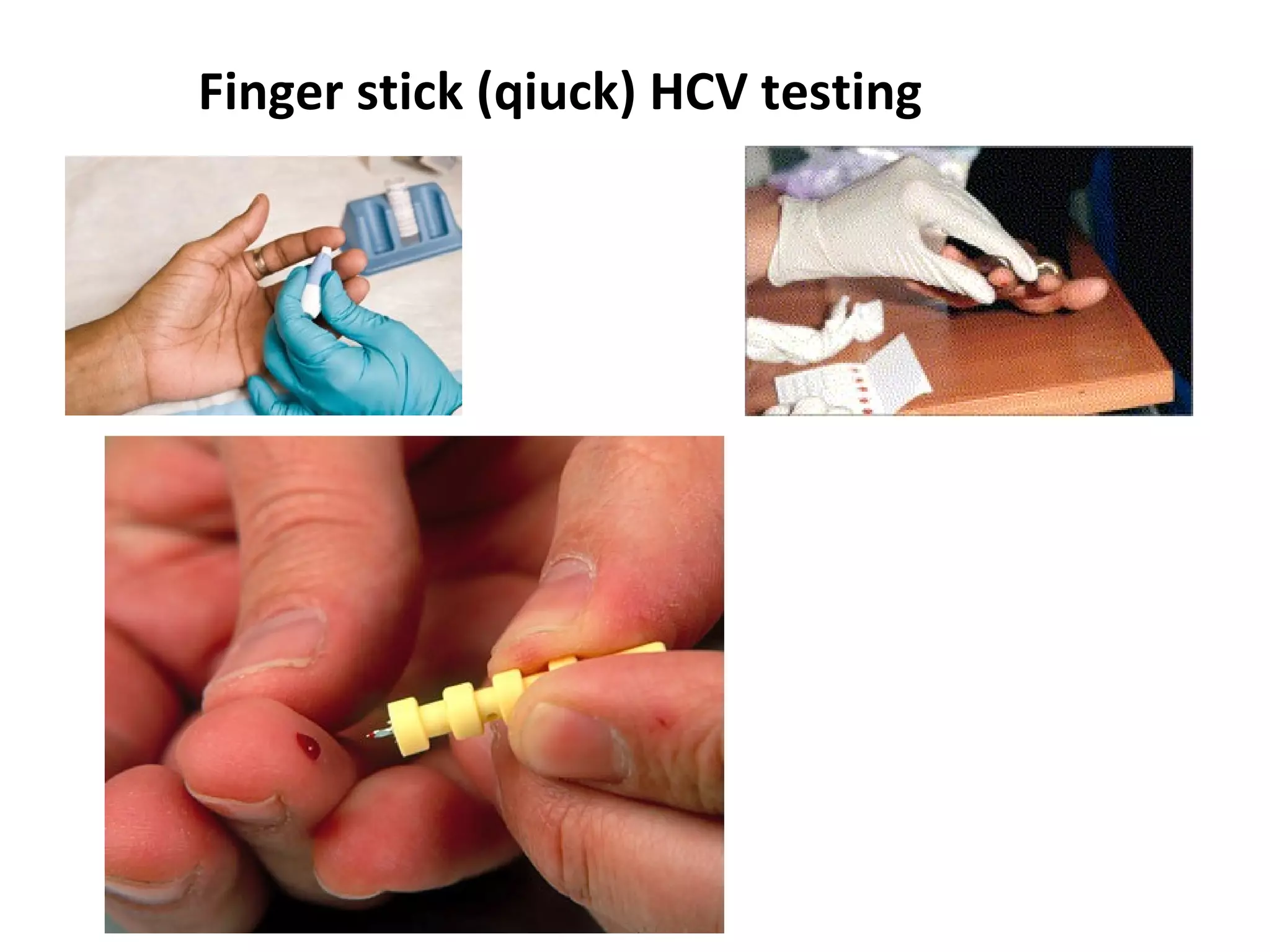 Finger stick (qiuck) HCV testing 