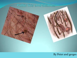 Pubic lice and Scabies  By Peter and gerges 