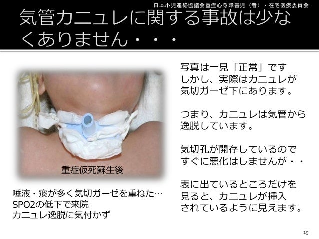 小児の気管切開ケアとカニュレ交換の実際