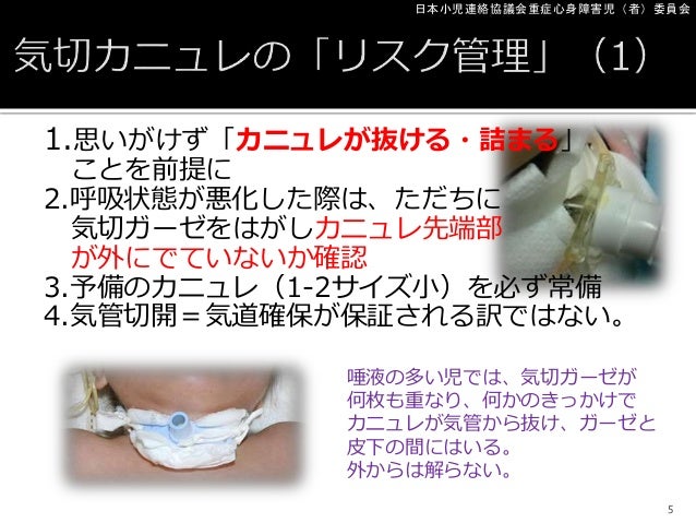 小児の気管切開ケアとカニュレ交換の実際