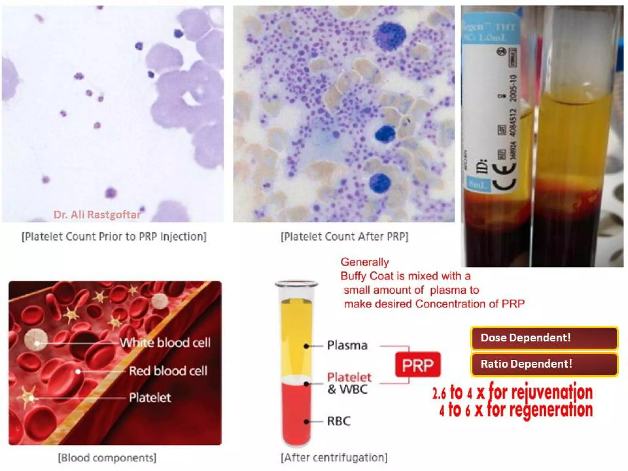 Platelet Rich Plasma Dr Rastgoftar | PDF