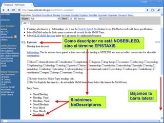 Como descriptor no está NOSEBLEED,
sino el término EPISTAXIS

Sinónimos
NoDescriptores

Bajamos la
barra lateral

 