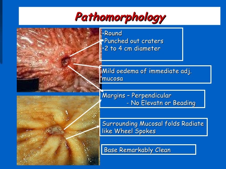 Peptic ulcer disease