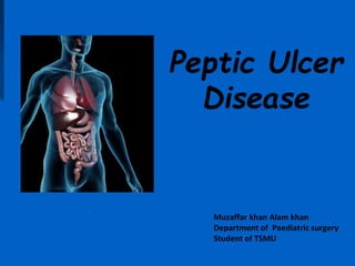 Peptic Ulcer
Disease
Muzaffar khan Alam khan
Department of Paediatric surgery
Student of TSMU
 
