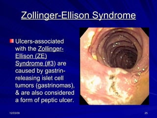 Zollinger-Ellison Syndrome Ulcers-associated with the  Zollinger-Ellison (ZE) Syndrome (#3 ) are caused by gastrin-releasing islet cell tumors (gastrinomas), & are also considered a form of peptic ulcer. 