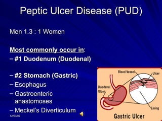Peptic Ulcer Disease (PUD) Men 1.3 : 1 Women Most commonly occur in : #1 Duodenum (Duodenal)  #2 Stomach (Gastric)   Esophagus Gastroenteric anastomoses Meckel’s Diverticulum 