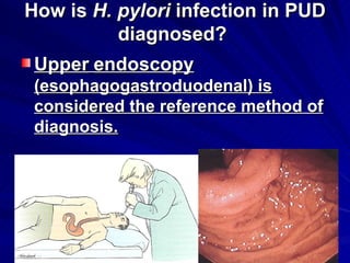 How is  H. pylori  infection in PUD diagnosed?  Upper   endoscopy  (esophagogastroduodenal) is considered the reference method of diagnosis.   