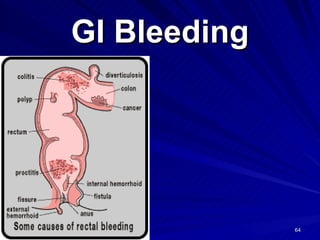 GI Bleeding 