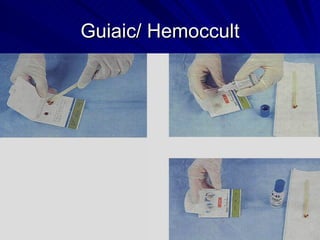Guiaic/ Hemoccult 