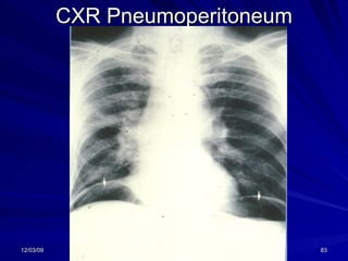 CXR Pneumoperitoneum 