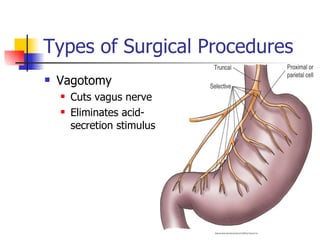 Types of Surgical Procedures Vagotomy Cuts vagus nerve Eliminates acid-secretion stimulus 