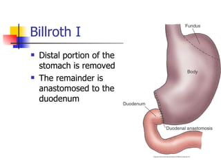 Billroth I Distal portion of the stomach is removed The remainder is anastomosed to the duodenum 