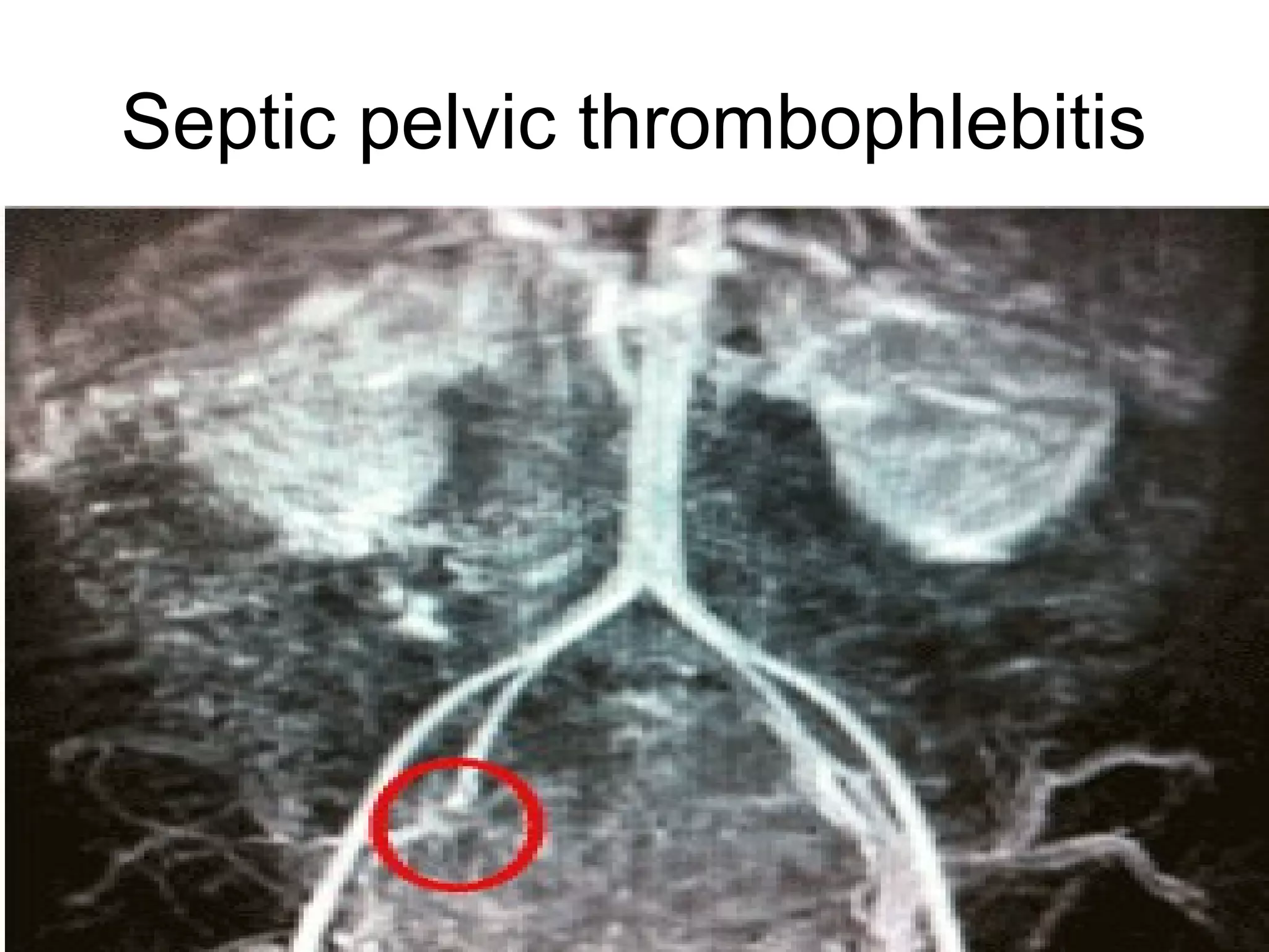 Puerperal sepsis | PPT