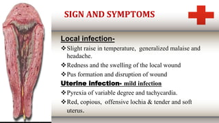 SIGN AND SYMPTOMS
Local infection-
Slight raise in temperature, generalized malaise and
headache.
Redness and the swelling of the local wound
Pus formation and disruption of wound
Uterine infection- mild infection
Pyrexia of variable degree and tachycardia.
Red, copious, offensive lochia & tender and soft
uterus.
 