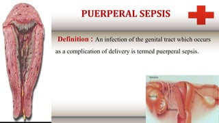 PUERPERAL SEPSIS
Definition : An infection of the genital tract which occurs
as a complication of delivery is termed puerperal sepsis.
 