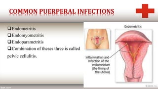 COMMON PUERPERAL INFECTIONS
Endometritis
Endomyometritis
Endoparametritis
Combination of theses three is called
pelvic cellulitis.
 