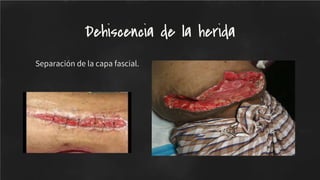 Separación de la capa fascial.
Dehiscencia de la herida
 