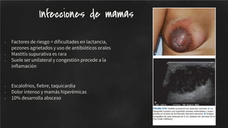 - Factores de riesgo = diﬁcultades en lactancia,
pezones agrietados y uso de antibióticos orales
- Mastitis supurativa es rara
- Suele ser unilateral y congestión precede a la
inﬂamación
- Escalofrios, ﬁebre, taquicardia
- Dolor intenso y mamás hiperémicas
- 10% desarrolla absceso
Infecciones de mamas
 