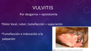VULVITIS
Por desgarros + episiotomía
•Dolor local, rubor, tumefacción + supuración
•Tumefacción e induración a la
palpación
 