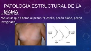 PATOLOGÍA ESTRUCTURAL DE LA
MAMACONGENITAS
•Aquellas que alteran al pezón  Atelia, pezón plano, pezón
invaginado
 
