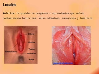 Locales
Vulvitis: Originadas en desgarros o episiotomías que sufren
contaminación bacteriana. Vulva edematosa, enrojecida y tumefacta.
 A consecuencia de los
 