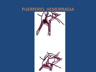 PUERPERIO. HEMORRAGIA
 