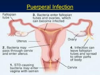 Puerperal Infection
 