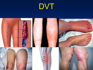 DVT
 