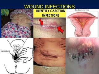 WOUND INFECTIONS
 