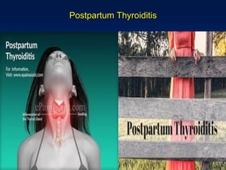 Postpartum Thyroiditis
 