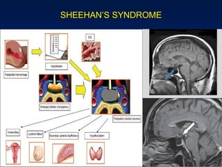 SHEEHAN’S SYNDROME
 
