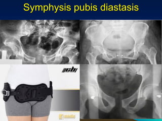 Symphysis pubis diastasis
 