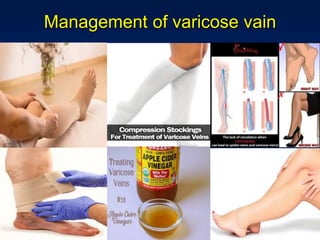 Management of varicose vain
 