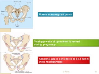 Normal non-pregnant pelvis 
Total gap width of up to 9mm is normal 
during pregnancy 
Abnormal gap is considered to be ≥ 10mm 
(note misalignment) 
O Warda 35 
 